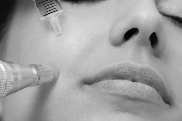 microneedling prp chemical peels