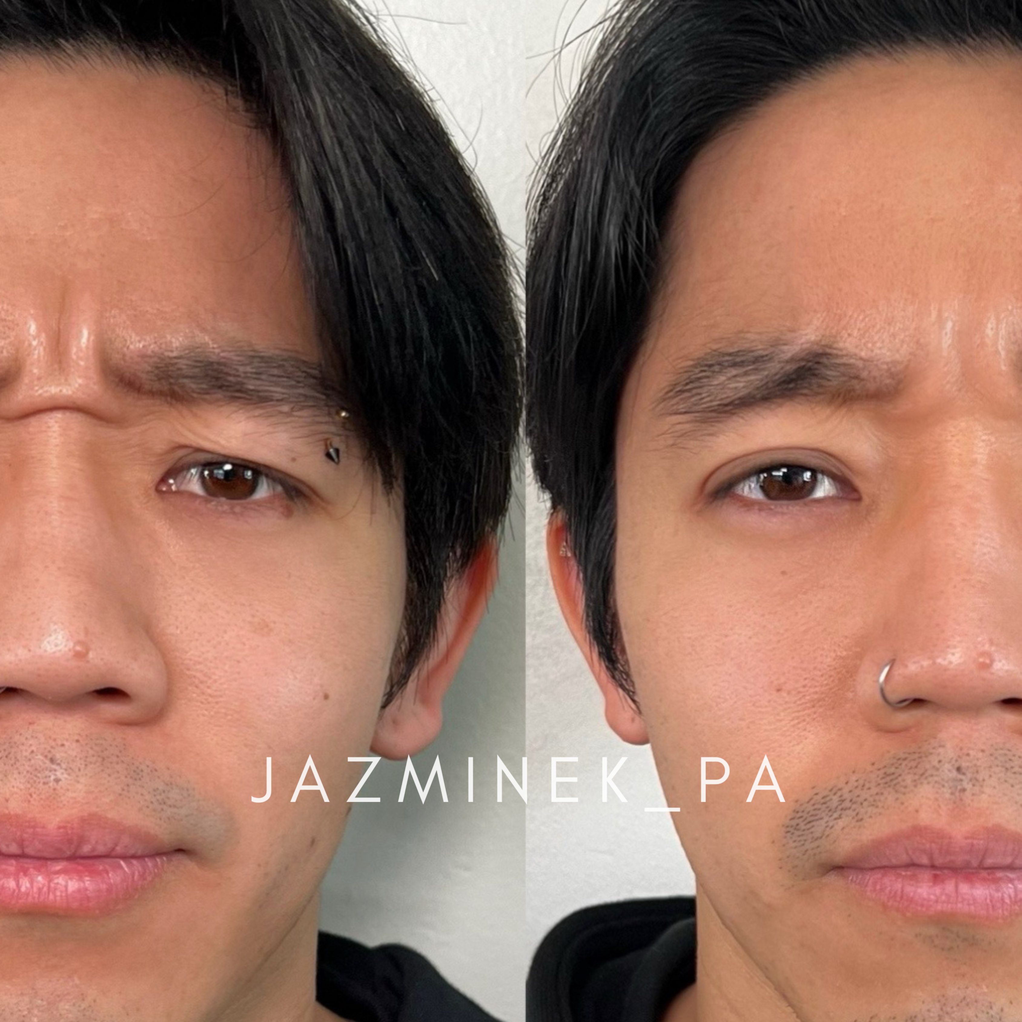 asian american chinese male with botox injections to forehead, smooth noticeable less wrinkles