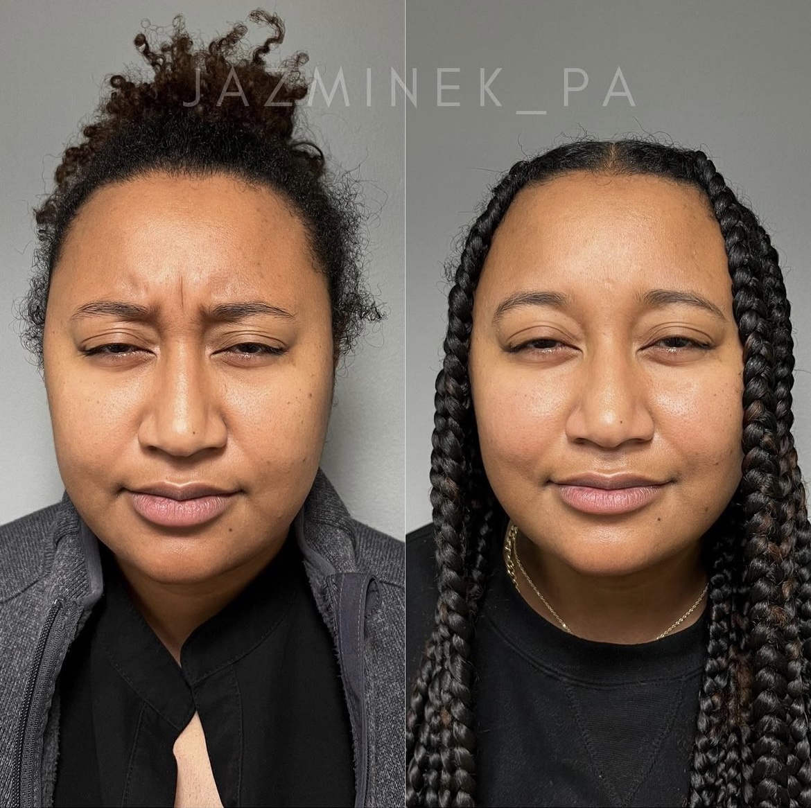 before and after of african american black female botox muscle relaxer toxin injections to forehead with skin improvements, well rested natural injectables